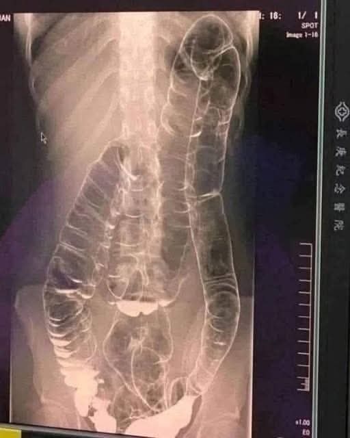 Severe Constipati.