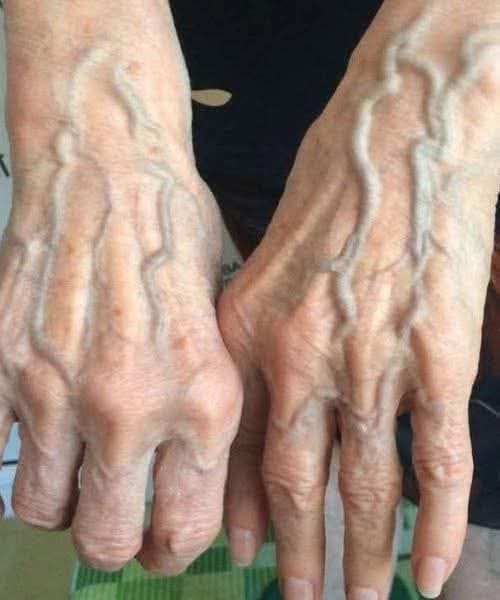 Why Your Veins Appear More Prominent Overnight